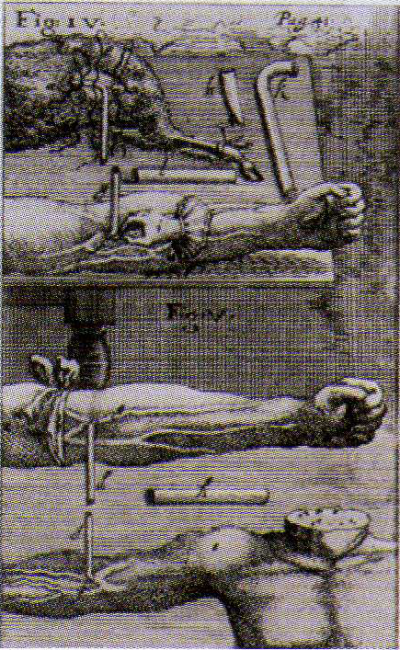 Histoire de la transfusion à travers les images (I)